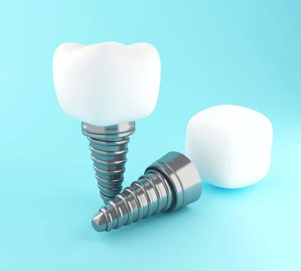 Quels sont les avantages des implants dentaires en clinique ?